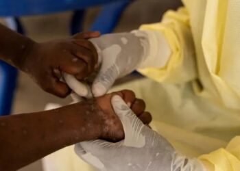 Mpox Reaches Pakistan and Sweden: 2024 Outbreak and Prevention Measures